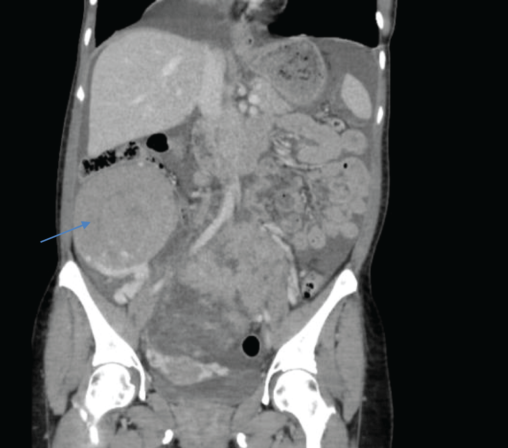 The tumor (→) contacts and displaces intestinal loops superiorly, as well as large retroperitoneal vessels.