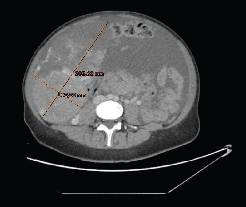 Large, vascularized, and heterogeneous masses that depended on both ovaries, the one on the right side measured 20 x 10 cm.