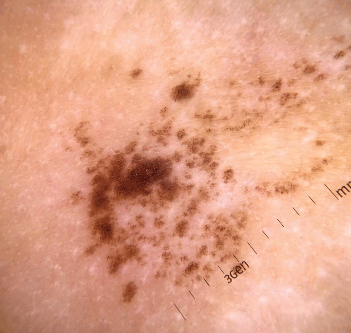 Dermoscopy: a reticular lesion with a regular pigmented network distributed in an agminated manner, interspersed with areas of healthy skin.