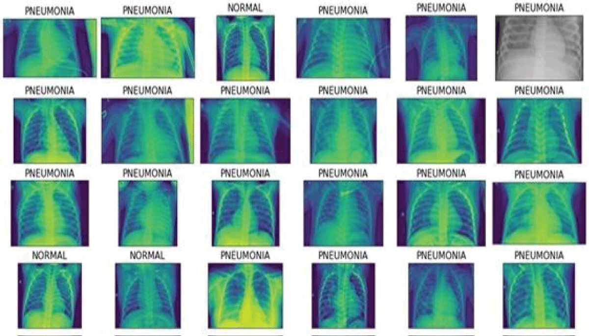 Pneumonia images.