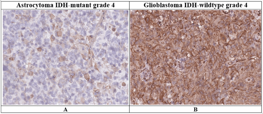 Vimentin expression in grade 4 astrocytoma IDH-mutant and IDH-wildtype glioblastoma (description in text).Immunohistochemical reaction, ×400A – Astrocytoma IDH-mutant grade 4.B – Glioblastoma IDH-wildtype grade 4.