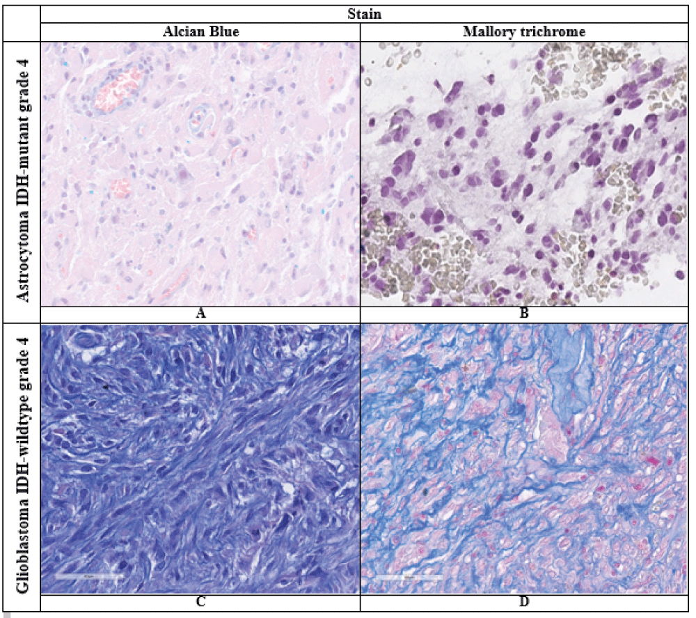 Results of histochemical reactions in the studied tumors (description in the text), ×400.A, C – Alcian blue stain;B, D – Mallory trichrome stain.