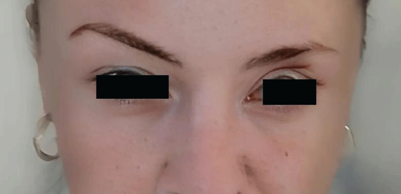 The patient's facial appearance 3,5 months post-surgery.