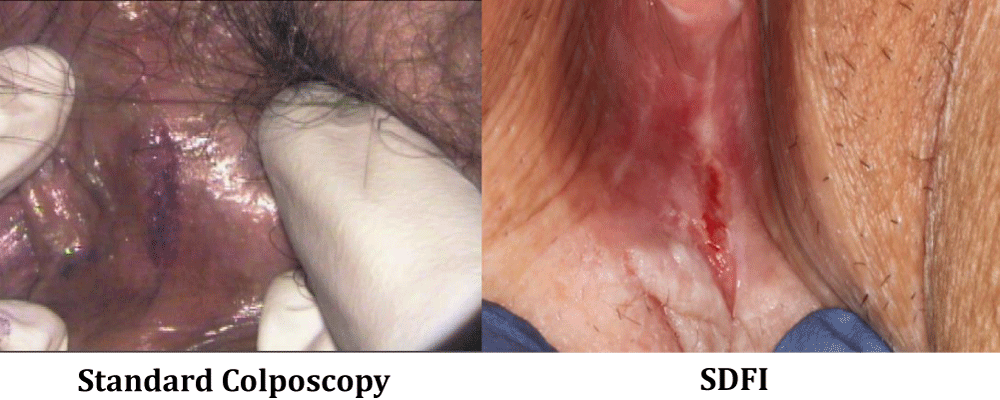 Side-by-side comparison of the two methods used. The photo on the left was taken using standard colonoscopy and toluidine staining: right minora laceration 1.5 cm. The photo on the right was taken using high resolution camera or SDFI: laceration in the fossa navicularis extending to the posterior fourchette 2.0 cm.