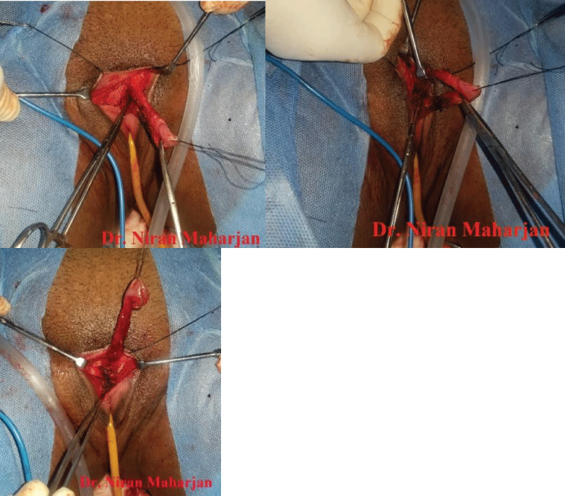 Intra-op pictures with entire clitoral portion dissection, component separation, and resection of the corporal segment with sparing of dorsal nerve tissue.